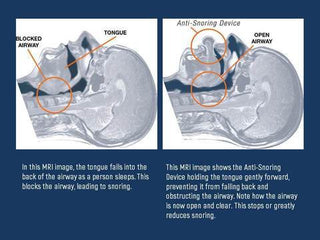 Anti-Snore Tongue Stabilizing Device Non-Invasive Nighttime Support - Image 4